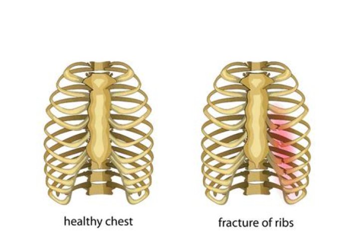How much is a cracked rib worth?