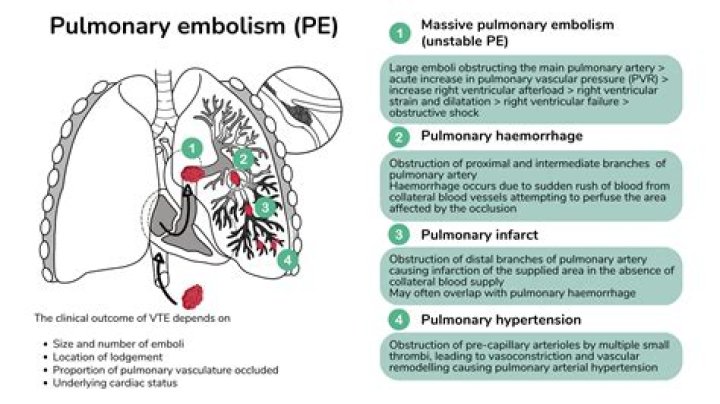 How painful are pulmonary embolisms?