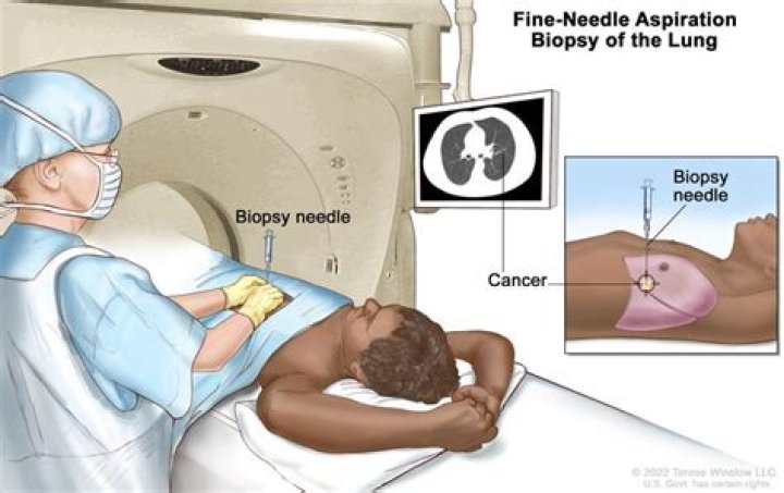 How painful is a lung biopsy?