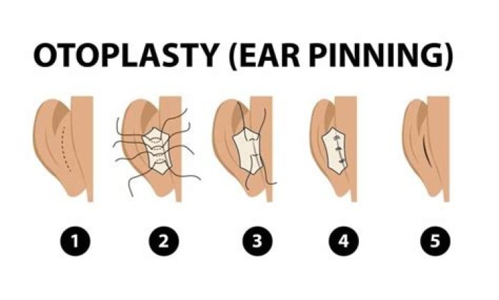 How painful is an otoplasty?
