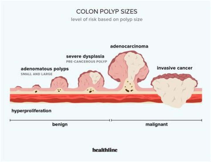 Is a 5 mm polyp big?