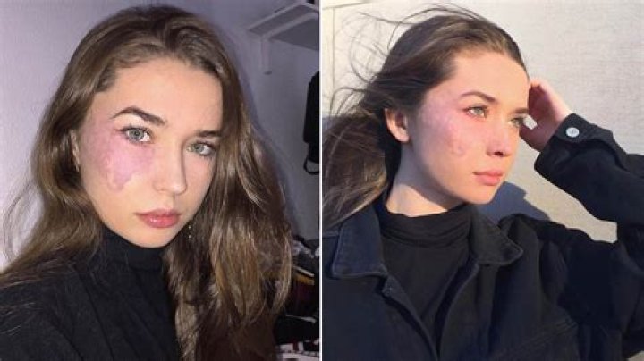 Is a birthmark a freckle?