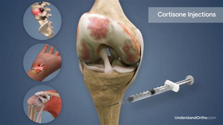 Is a cortisone shot worth it?