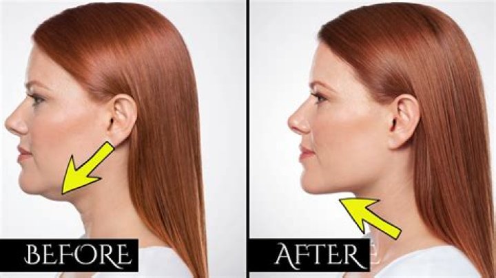 Is a double chin permanent?