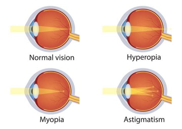 Is astigmatism a birth defect?