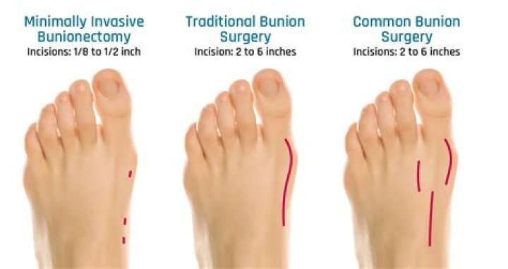 Is bunion surgery worth having?