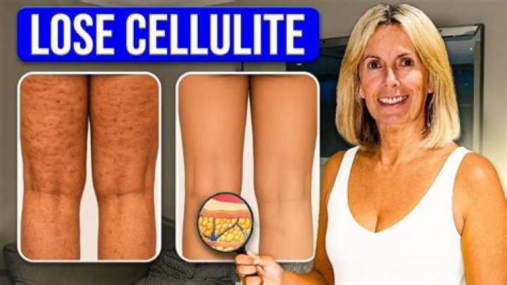 Is cellulite because of dehydration?