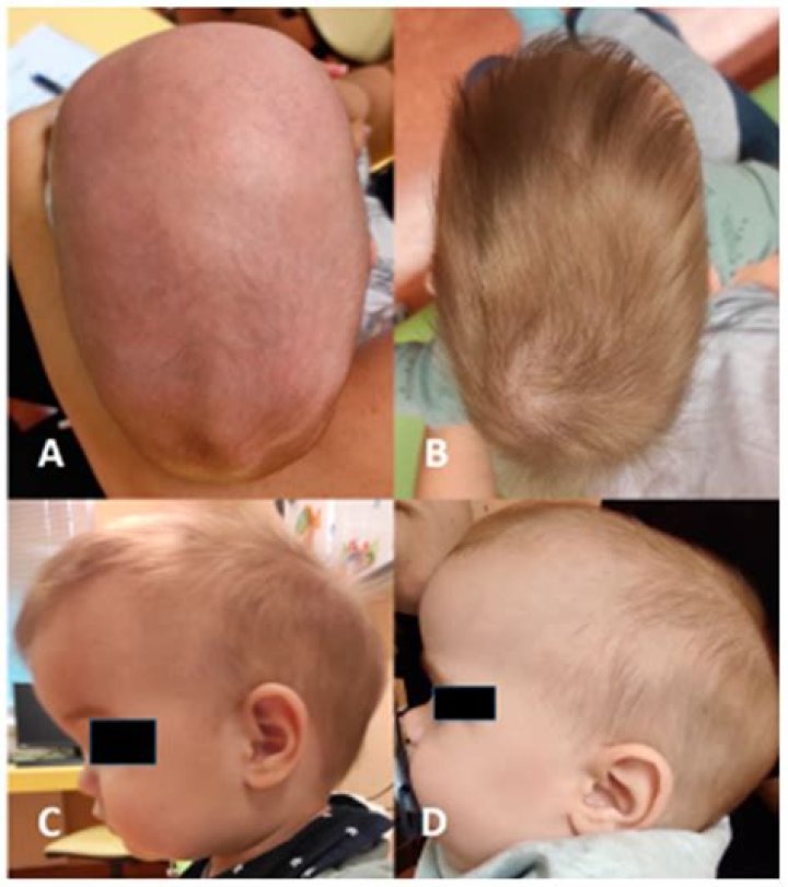Is craniosynostosis a major surgery?