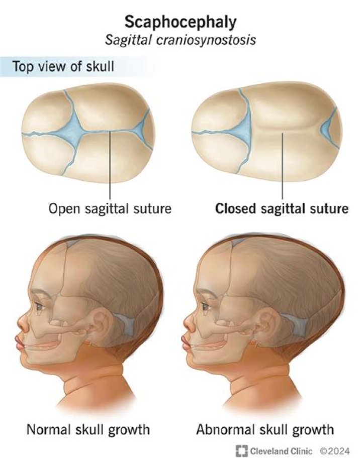 Is craniosynostosis curable?