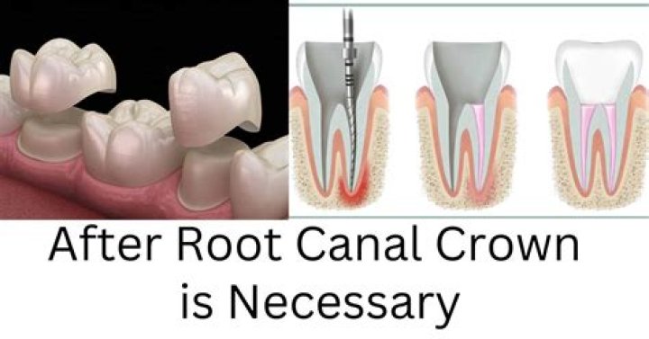 Is crown necessary after root canal?