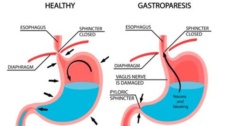 Is gastroparesis long life?