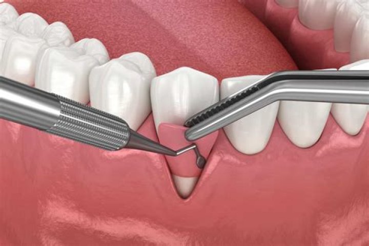 Is gum grafting painful?