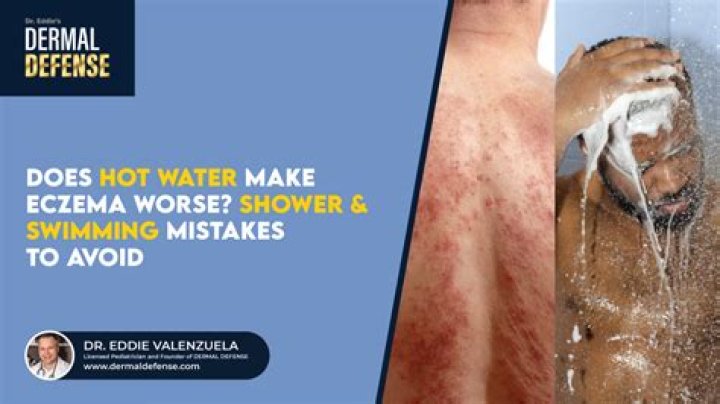 Is hot water good for eczema?
