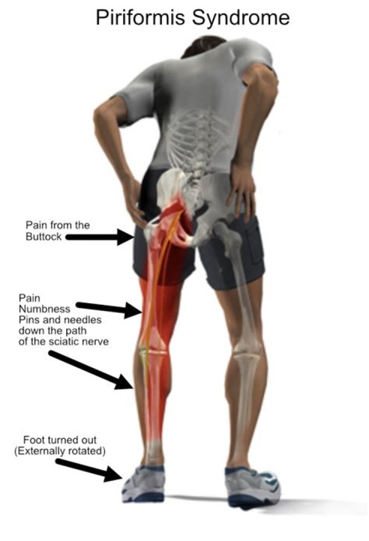 Is ibuprofen good for piriformis syndrome?
