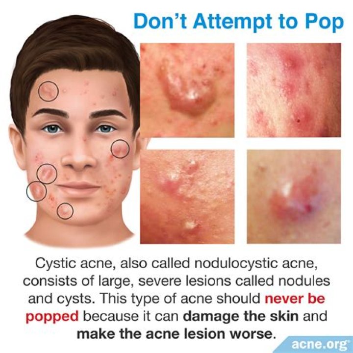 Is it good to pop pimples with pus?