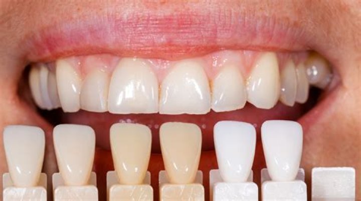 Is it worth it to get veneers?