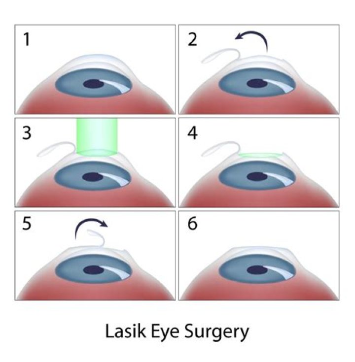 Is LASIK safe in 2021?