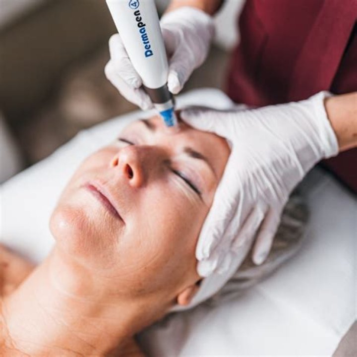 Is microneedling permanent for scars?