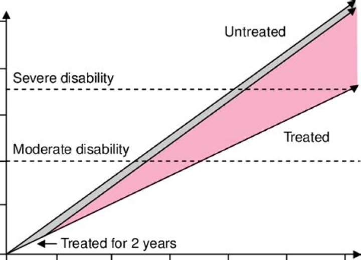 Is MS fatal if untreated?