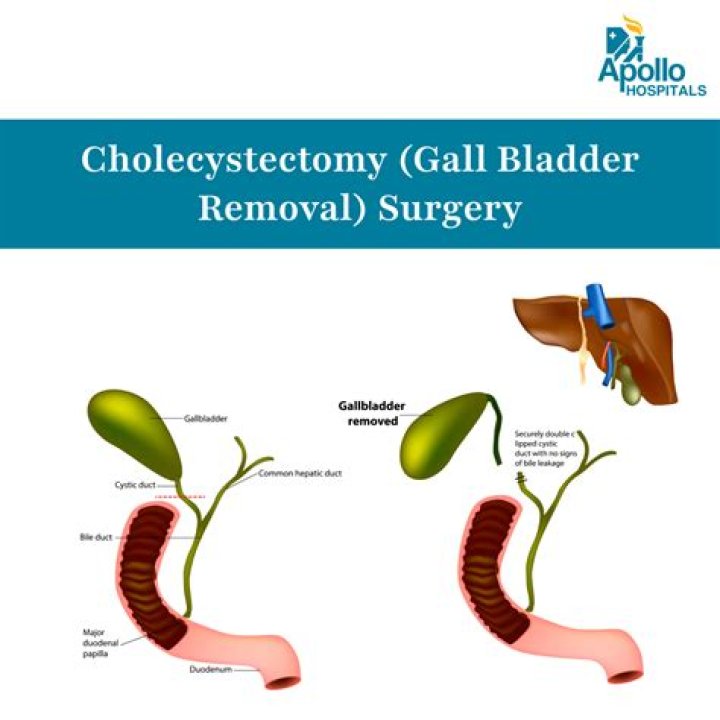 Is ovarian cyst removal a major surgery?
