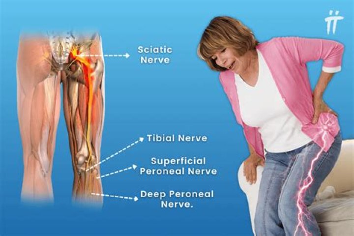 Is prednisone good for sciatica?