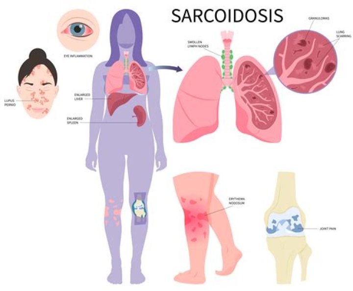 Is sarcoidosis a terminal illness?