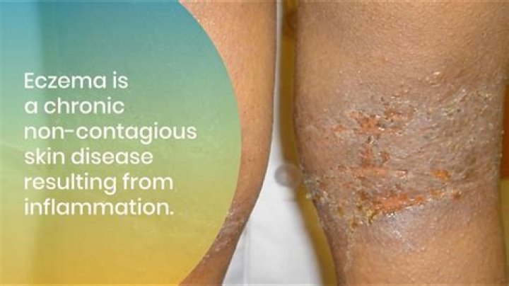 Is sweating good for eczema?