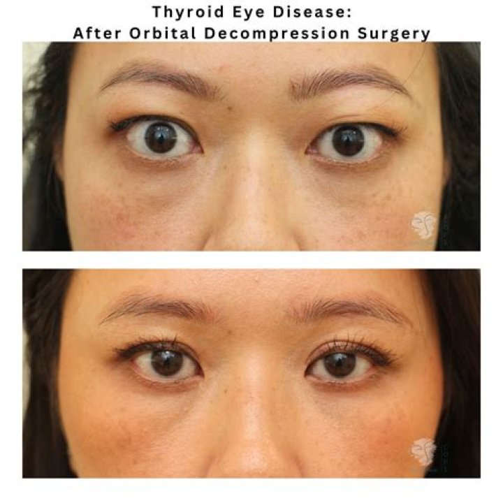 Is there a cure for thyroid eye disease?