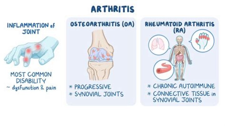 Is there a difference between arthritis and osteoarthritis?