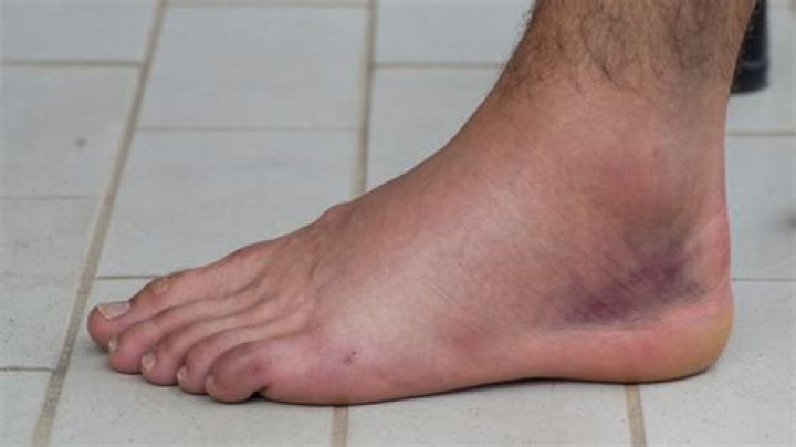 Is Tylenol or ibuprofen better for a sprained ankle?