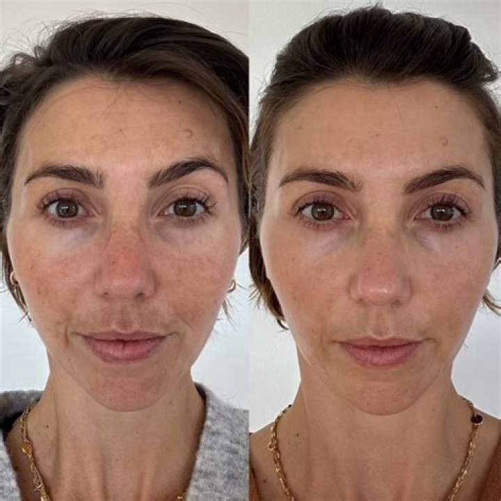 Is vitamin C serum good after microneedling?