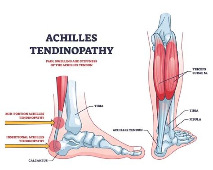 Is walking good for Achilles tendonitis?