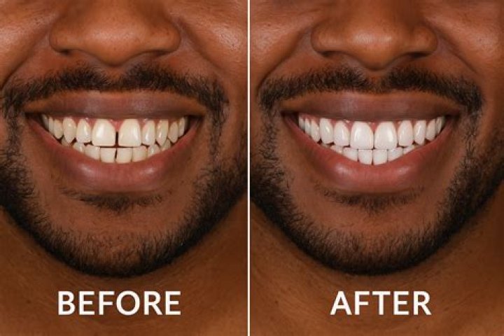 Should I get veneers on my bottom teeth?