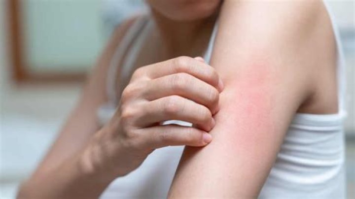 Should I put lotion on a rash?