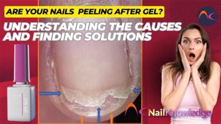 Should you buff peeling nails?