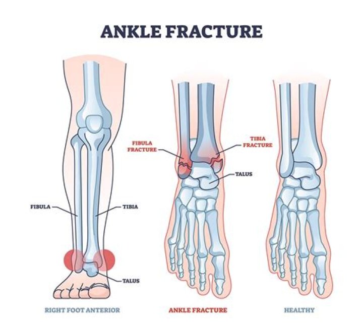 What's worse a break or a fracture?