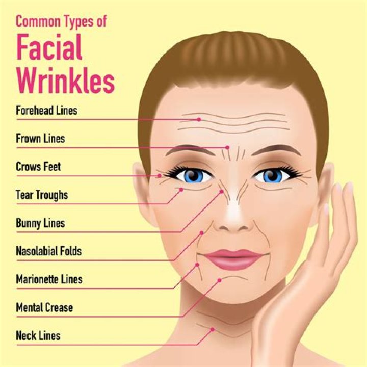 What are marionette lines on face?
