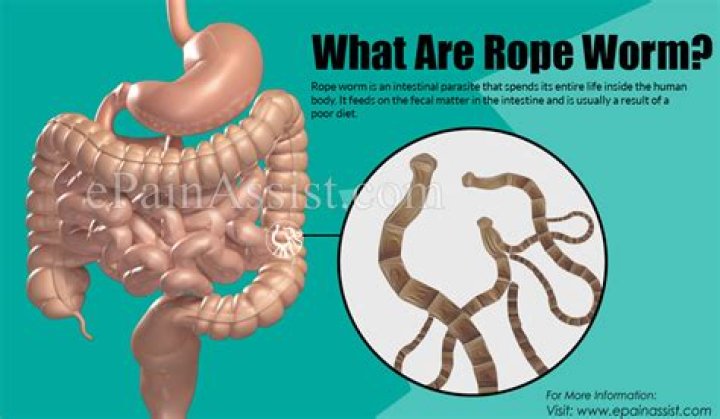 What are rope worms in humans?