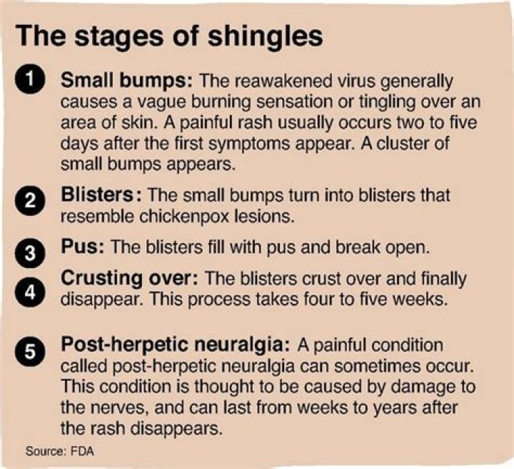 What are the 4 stages of shingles?