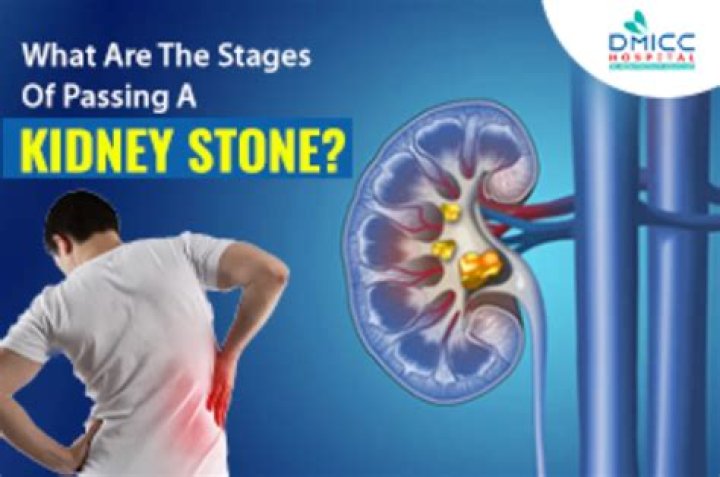 What are the first signs of passing a kidney stone?
