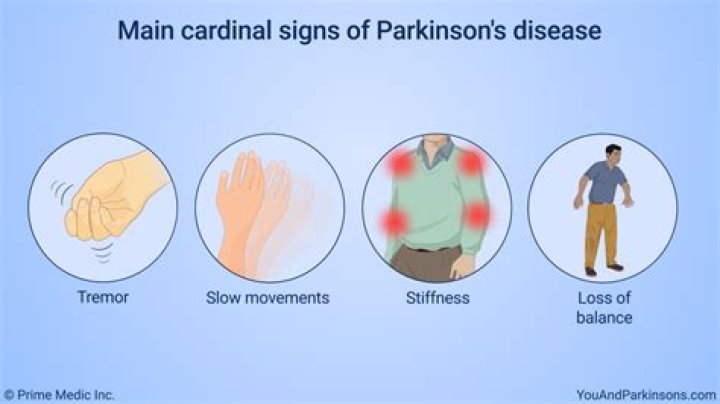 What are the four cardinal signs of Parkinson's disease?
