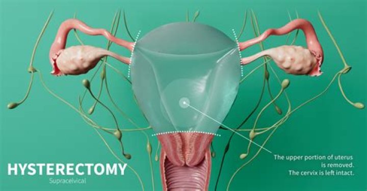 What are the negative effects of having a hysterectomy?