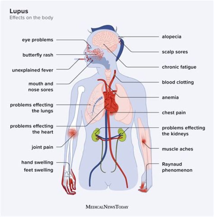 What are the top 5 signs of lupus?