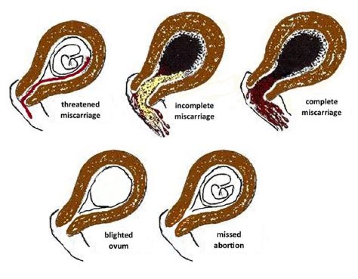 What blood types cause miscarriages?
