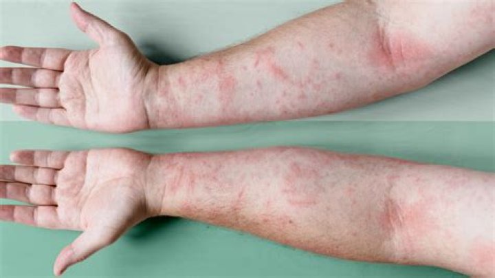 What can calm down eczema?