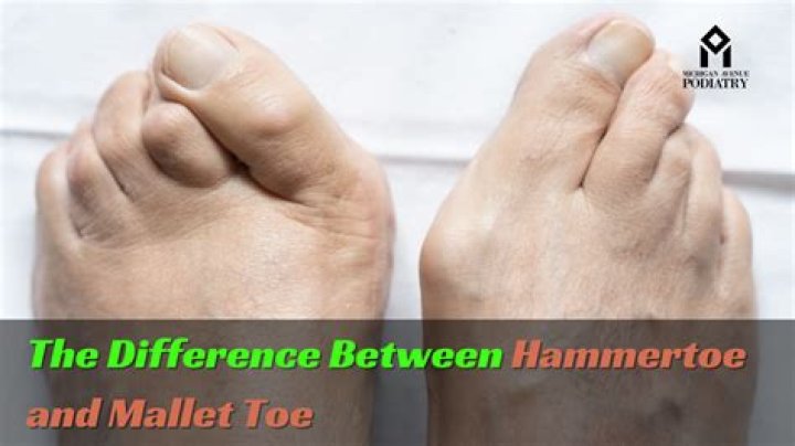 What can you do about hammer toes?
