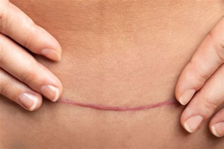 What can you not do 2 weeks after C-section?