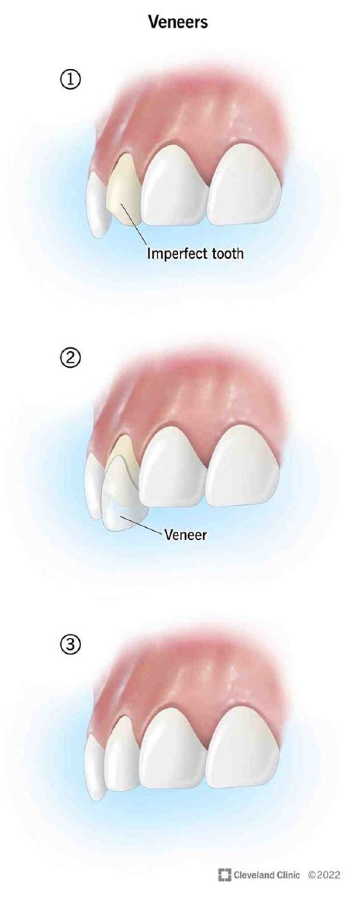 What can you not eat with veneers?