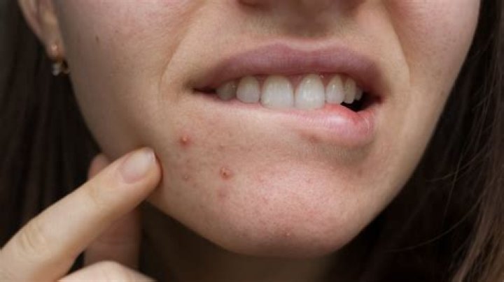 What causes a love Pimple?