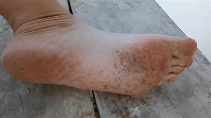 What causes dark spots on feet?